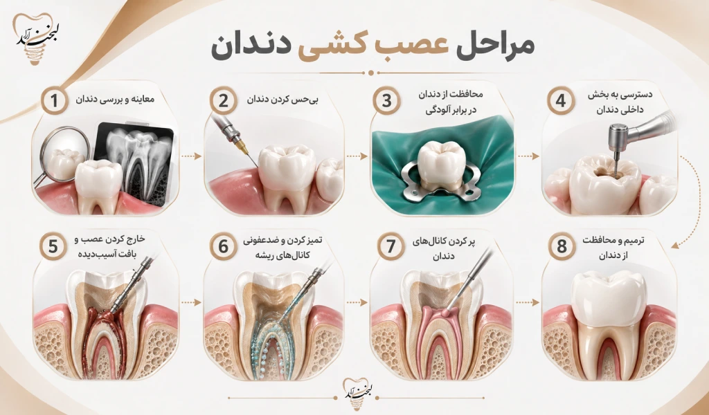 مراحل عصب کشی دندان