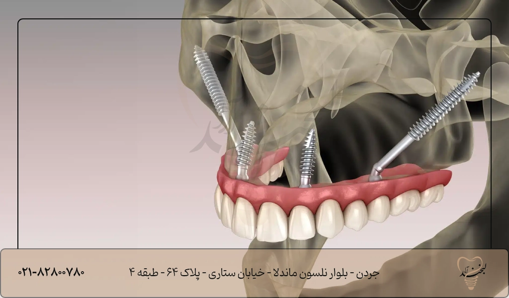 ایمپلنت زیگوماتیک چیست؟