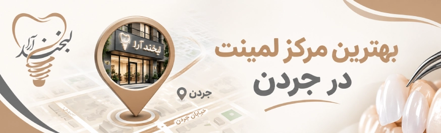لمینت دندان در جردن؛ راهنمای انتخاب بهترین مرکز و دکتر لمینت