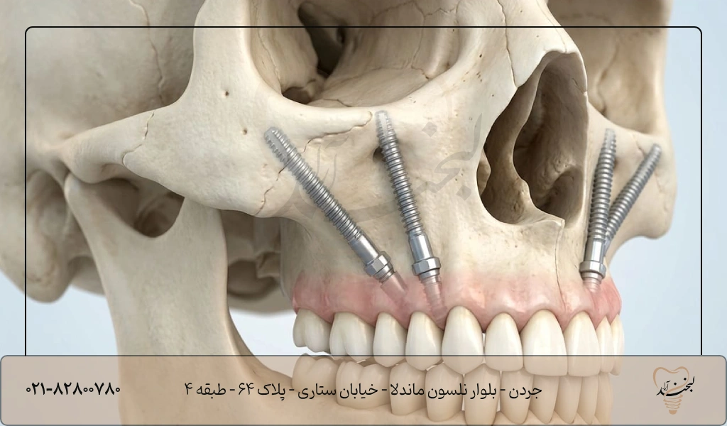هزینه کاشت ایمپلنت زیگوماتیک