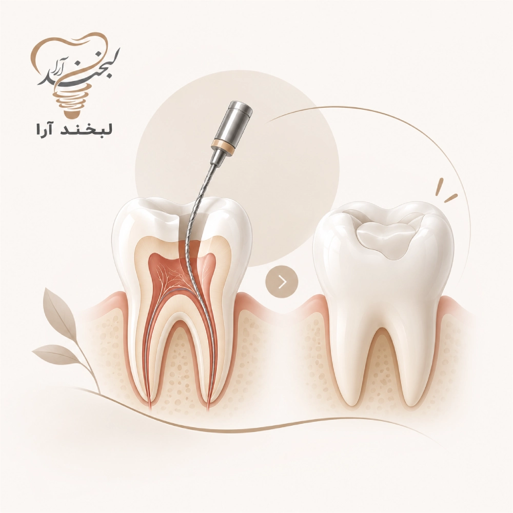 قیمت پرکردن دندان با عصب کشی