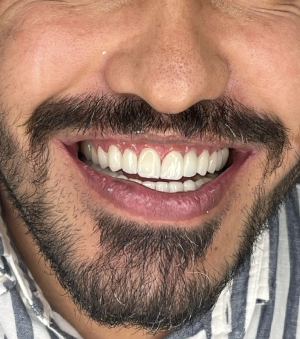 ایمپلنت دندان در لبخند آرا