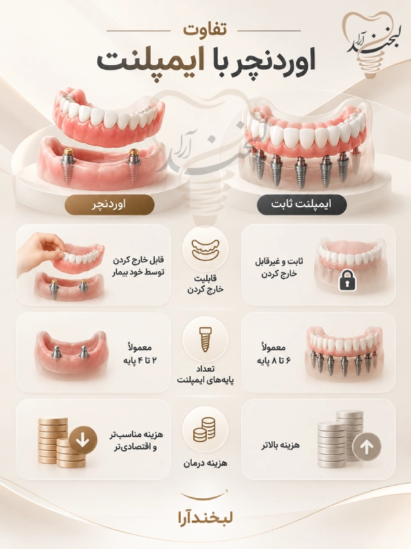 تفاوت اوردنچر با ایمپلنت