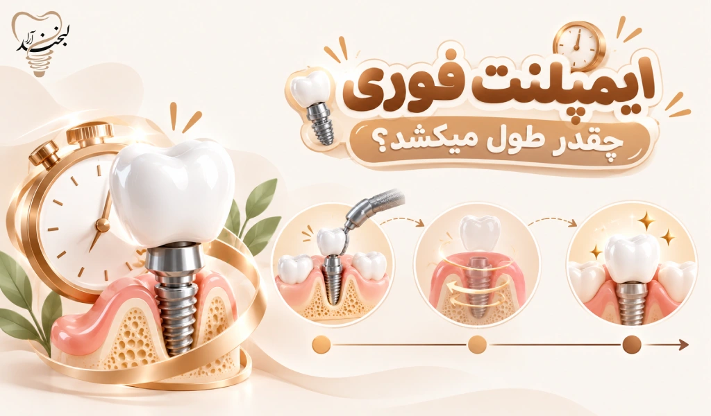 ایمپلنت فوری چقدر طول میکشد؟