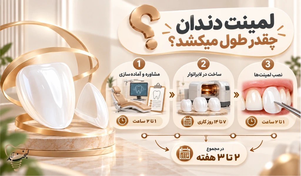 لمینت دندان چقدر طول میکشد؟