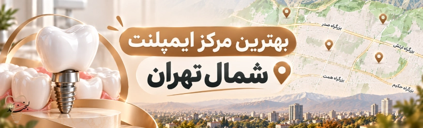 ایمپلنت در شمال تهران؛ راهنمای انتخاب مرکز و دکتر ایمپلنت شمال تهران