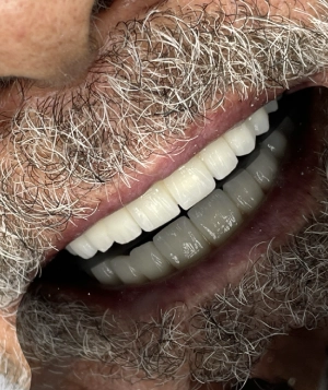 ایمپلنت در لبخند آرا